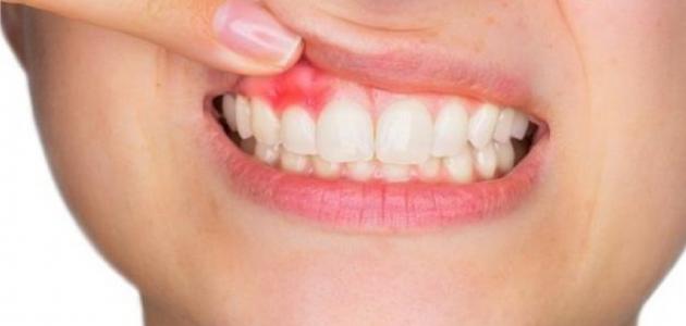 خراج الأسنان: الأسباب، الأعراض، وطرق العلاج المنزلي الفعّالة