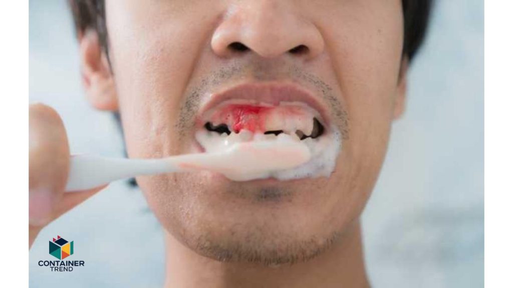 Bleeding-gums-1-1024x576 علاج نزيف اللثة في المنزل وصفات طبيعية مجربة ومضمونة