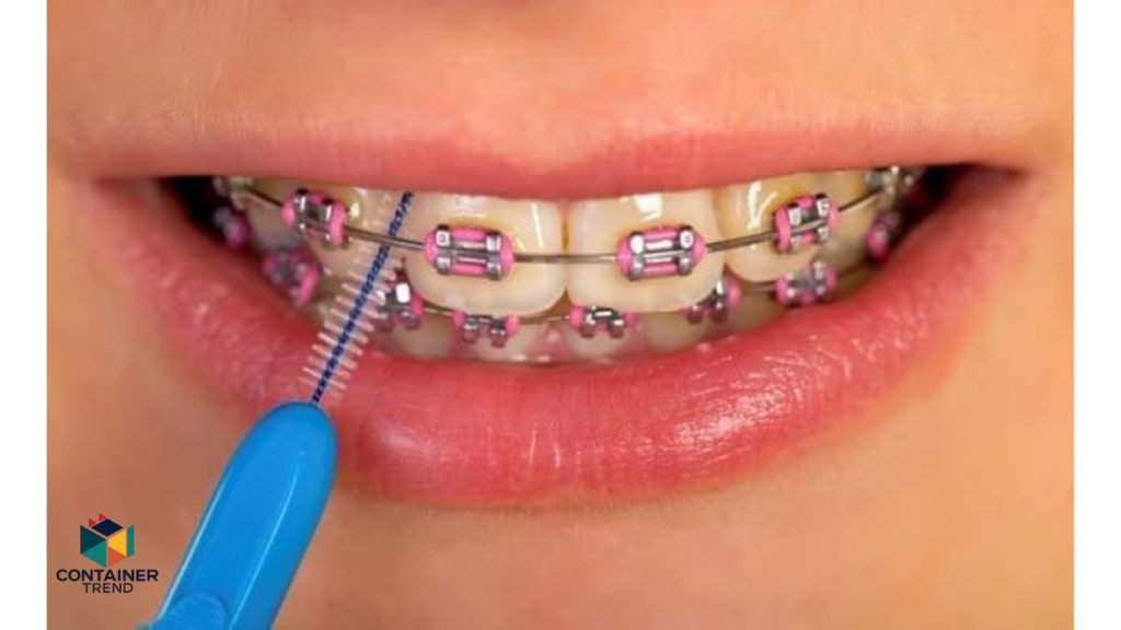أضرار تقويم الأسنان متى تكون مشكلة؟ وكيف تتجنبها؟