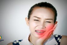 أضرار تقويم الأسنان متى تكون مشكلة؟ وكيف تتجنبها؟