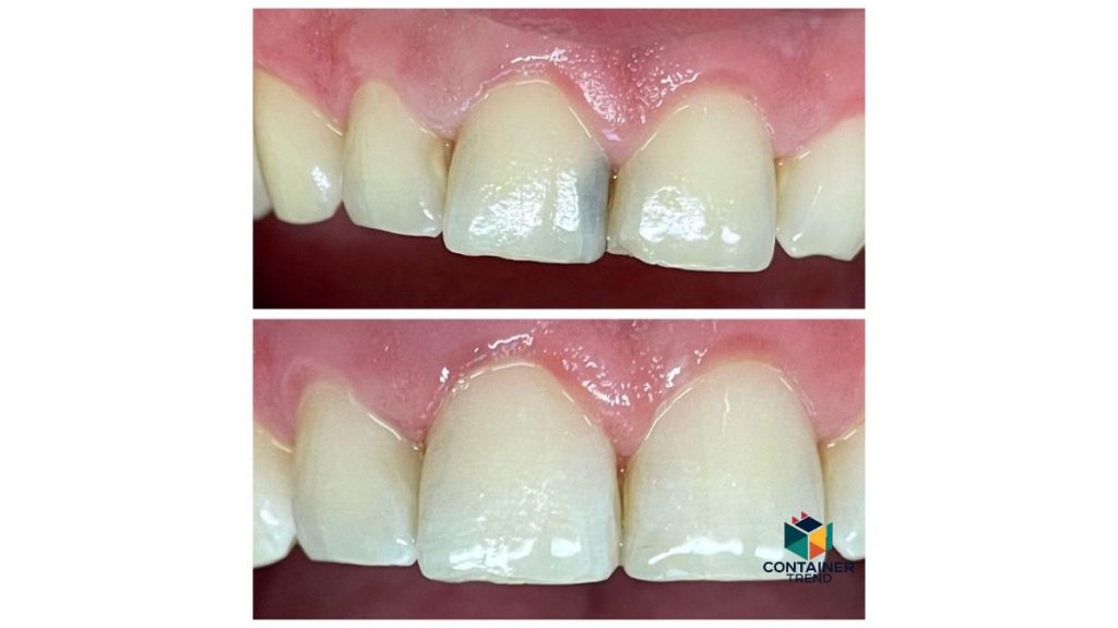 Tooth-decay-4-1024x576 أسباب تسوس الأسنان وكيفية الوقاية منه بطرق سهلة وفعّالة في عام 2025