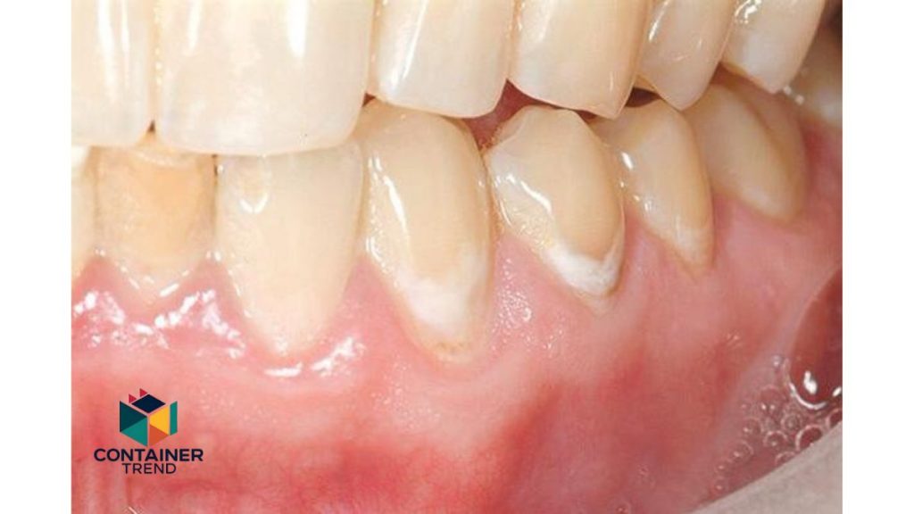 tooth-decay-2-1-1-1024x576 طريقة التخلص من تسوس الأسنان في يوم واحد 2025