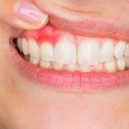 خراج الأسنان: الأسباب، الأعراض، وطرق العلاج المنزلي الفعّالة